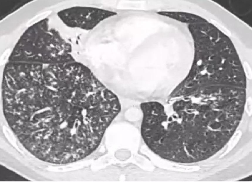 Mycoplasma 5