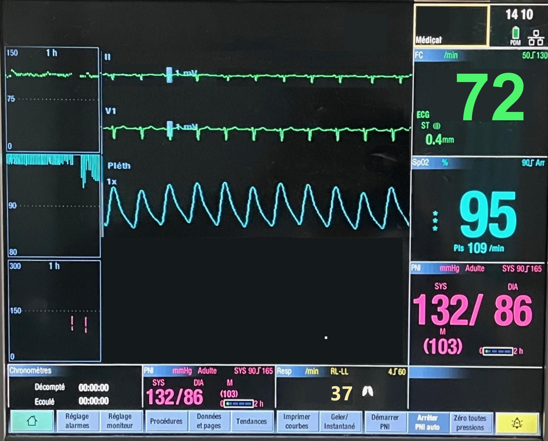 Scope 72 bpm
